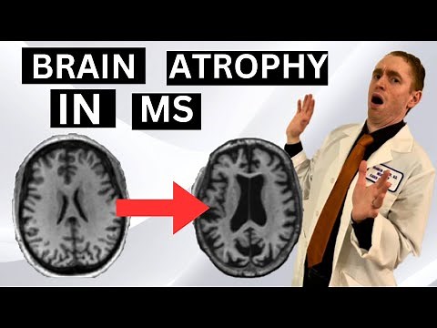 Brain Atrophy in Multiple Sclerosis Explained by Neurologist