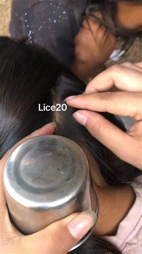 #Lice #😱 #omg #