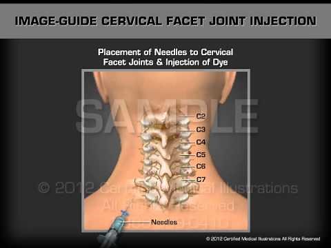 Image Guide Cervical Facet Joint Injection