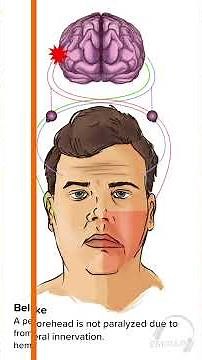 Bell Palsy vs Stroke
