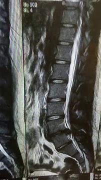 How to read your own lumbar spine MRI. L4-L5 Herniated disc