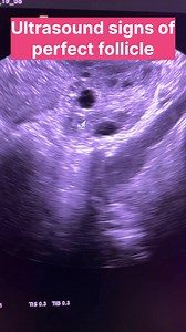 35K views · 267 reactions | Follicular monitoring is a serial ultrasound to track the growth of the follicles #follicularphase #Follicularmonitoring #dominantfollicle #follicle #folliclehealth #ovulation #OvulationTracking #ovulationphase | Dr home - Dr shikha Agarwal | Facebook