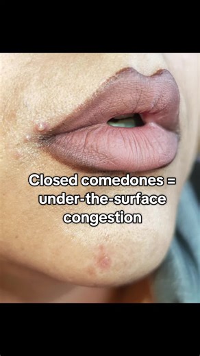 Effective Steps for Treating Closed Comedones