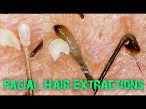 Facial Hair|Satisfying Close up Extractions