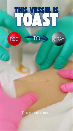 Tiny red dot on the skin? #dermatologist #spiderangioma #shorts