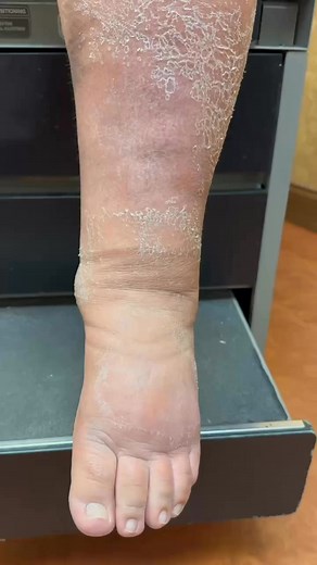 Lymphedema increases the risk of developing cellulitis because it causes fluid buildup and poor lymphatic drainage, creating an environment where bacteria can thrive. Here’s how this happens: 1. Impaired Immune Response – The lymphatic system plays a crucial role in immune function by transporting white blood cells and removing pathogens. When lymph flow is obstructed, the body has a harder time fighting infections. 2. Skin Barrier Compromise – Swollen tissues and stretched skin in lymphedema ar