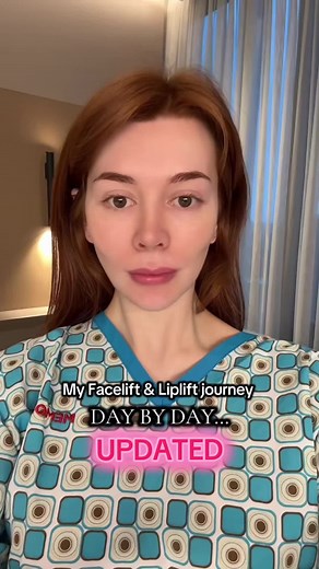 Facelift & Liplift Journey UPDATED: Before & After