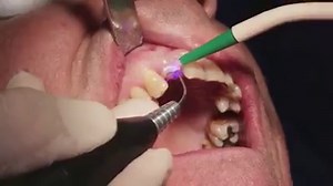 SIROLaser Blue: #Implant uncovery (Cutting efficiency in realtime) The compact SIROLaser Blue is the first dental diode laser to have a blue, an infrared, and a red diode. This enables it to cover a range of more than 20 indications – and therefore virtually infinite possibilities for application in your practice routine. Learn more: http://bit.ly/1PFJYVE | Dentsply Sirona