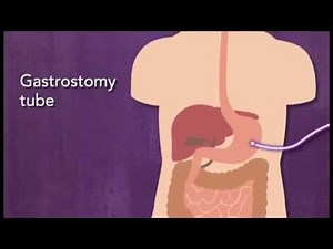 Why are there different types of feeding tubes?