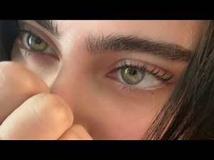 sunken eye filler˚˖💉 ELIMINATE dark circles 🧖🏻‍♀️{ EXP }