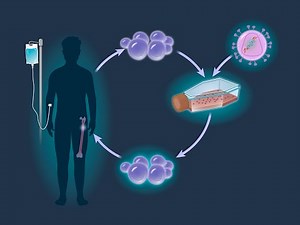 LentiGlobin for Sickle Cell Disease | NEJM