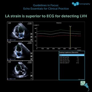 Did you know? Heart Failure: Left atrial strain correlates with NT-proBNP levels in both Heart Failure with preserved Ejection Fraction (HFpEF) and Heart Failure with reduced Ejection Fraction (HFrEF), and it serves as a marker for prognosis in these conditions This topic and many related questions will be covered in our first Webinar on the topic Hypertension - Guidelines Update and FAQs – It is part of our course! Get our Guidelines in Focus course now for a special discount 👉 https://zurl.co