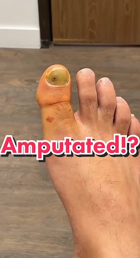 Amputated!? Getting my toe amputated every 6 months