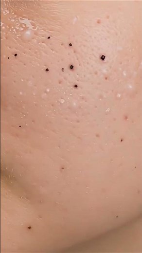 Satisfying ASMR | Deep Pore Cleaning & Gentle Suction Whitehead Removal | Relaxing Spa Facial Sound.