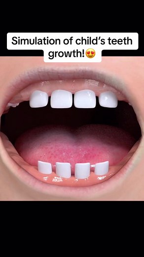 Simulation of child’s teeth growth🤩 . . . . . . . #tiktok #love #like #follow #explore #2023 #meme #orthodontics #orthodontist #duet #repost #babyteeth #sundayfunday #tiktokfamous #tiktoktrend #viralvideos #viralpost #dental #dentist #dentistry #shqipe #dentalimplants #learnontiktok #fypシ #foryoupage #fypシ゚viral #learnontiktok #braces #shqipnia #kosova