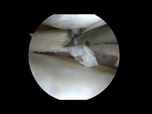 Arthroscopic partial medial meniscectomy