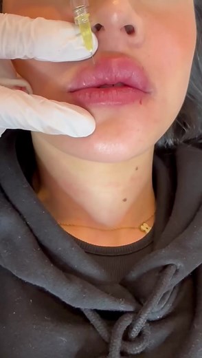 Injection d’acide hyaluronique pour lèvres magnifiques