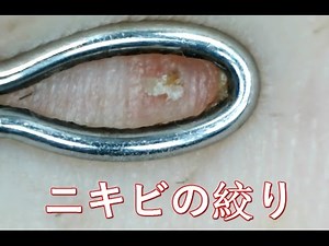 にきび zit ニキビ Acne ニキビの絞り (All about health)