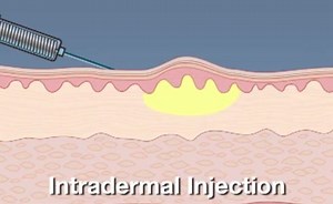 Types Of Injections
