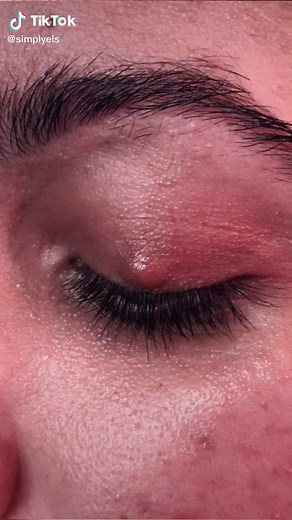 Chalazion Removal Procedure Revealed