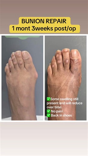 bunion deformity can be painful to patients when they walk, stand, wear shoes, etc. In this picture, this patient is almost 2 months post repair of the bunion deformity. She is doing extremely well. She has no pain, she has no discomfort and is ready to get the other foot done lol. ##Bunion##Toe##Hammertoes##Feet##UglyFeet