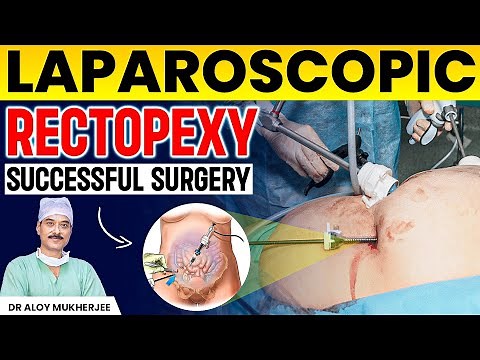 Laparoscopic Rectopexy Successful Surgery | How to Manage Constipation After Surgery