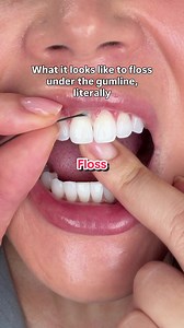 Black Expanding Floss Removing Plaque at the Gumline