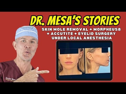 Dr. Mesa Story 142: Mole Removal + Morpheus8 + Accutite & Eyelid Surgery under Local Anesthesia
