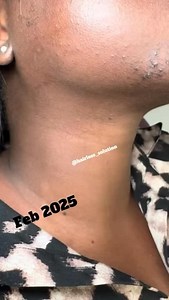 6 months of consistency = a lifetime of confidence. 💫 Electrolysis really changes everything. Click link in my bio to book / visit our website www.hairlesssolution.com ✅Follow @hairless_solution @hairless_solution #pcos #reels #laserhairremoval#fyp #esthetics #explorepage #hormonalacne #viralreels #foryou #electrolysisatlanta #electrolysis #hairlesssolution #electrologist #atlelectrolysis #georgia | Hairless Solution Electrolysis