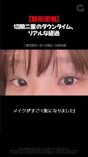 切開二重まぶた＋目元矯正腫れはいつ頃治るのだろうか？