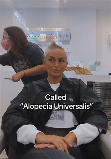 Alopecia Universalis: My Journey Through Hair Loss