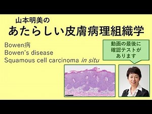 New Skin Histopathology: Bowen's Disease, Squamous Cell Carcinoma in Situ