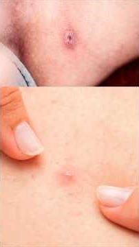 Bumps and itching in the groin? Careful! It could be folliculitis 😨