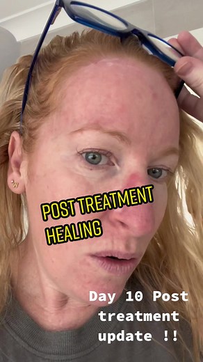 Living with skin cancer, post PDT CO2 laser treatment update. Sorry it’s taken so long it was a brutal week, feeling overwhelmed by your love and well wishes. Peeling skin layers off. Just don’t want anyone to go this journey of pain. Look after your skin it’s super important ❤️#skincancer #skincancerawareness #skincancercheck #beauty #foryoupage #foryou #photodynamictherapy #melanoma #scc #bcc #australiansun #notworthit #lookafteryourself #pain #ouch #burn @DermDoctor | Dr. Shah @Dr Adel | Derm