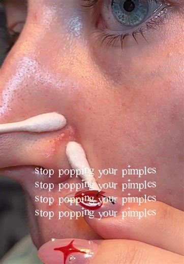 How to Gently Pop Whiteheads Safely