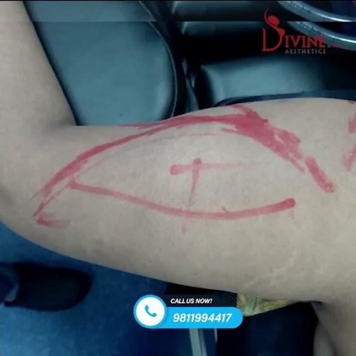 Arm Liposuction Result | Liposuction Surgery and Immediate Result | Dr. Amit Gupta