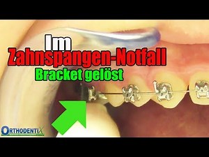 Im Zahnspangen-Notfall, ein Bracket hat sich gelöst, feste Zahnspange, Kieferorthopöde | Orthodentix