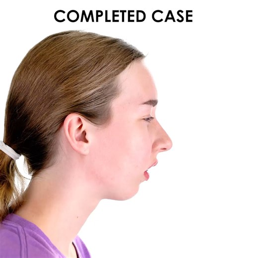 Movahed OMS on Instagram: "Before & after morphs This patient first consulted with Movahed OMS in 2021 at the age of 13, because her mother was concerned about her misaligned bite and chronic jaw pain. Following an MRI, Dr. Movahed diagnosed her with Idiopathic Condylar Resorption (ICR) due to deteriorating joints. It was decided that she may need surgery at a later date once her bones stopped growing. She returned in 2023 and another MRI confirmed her joints had deteriorated further and were un