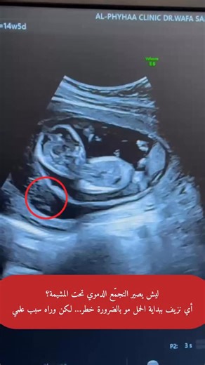 ما هو التجمّع الدموي تحت المشيمة؟ (Subchorionic Hematoma) هو تجمّع للدم يحدث بين المشيمة وجدار الرحم، ويظهر غالبًا في بدايات الحمل، ويتم اكتشافه عادةً عن طريق فحص السونار � الأسباب المحتملة: • انفصال جزئي وبسيط للمشيمة عن جدار الرحم • انغراس المشيمة بطريقة غير مستقرة • مجهود بدني زائد أو حمل أشياء ثقيلة • وفي بعض الأحيان قد يحدث دون سبب واضح 🔹 نتائجه وتأثيره: • في معظم الحالات يكون بسيطًا ويختفي تلقائيًا مع الوقت • قد يسبب: ◦ نزيفًا مهبليًا خفيفًا إلى متوسط ◦ ألمًا خفيفًا أحيانًا • • إذا كان كب