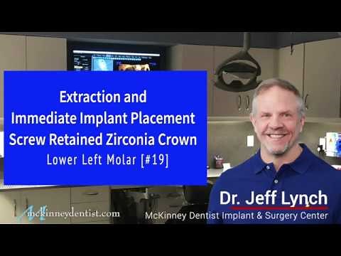 Extraction Implant #19 Dr Jeff Lynch