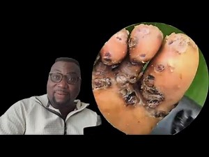 Deep Jigger Extraction | Heel Cleaning Therapy W03612Y