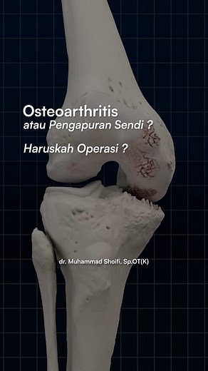 Penanganan Osteoartritis: Operasi Tidak Selalu Diperlukan