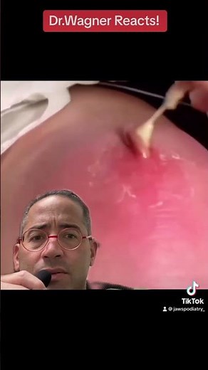 EXPLOSIVE ABSCESS💦#shorts