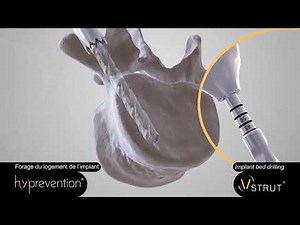 V-STRUT Operative Technique USA