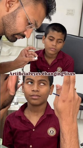 Dr Vikas Gupta, MDS (Ex PGI) | Chandigarh Facial Prosthetics on Instagram: "Mother’s pure reaction after Son receives Customised Artificial Eye. At Chandigarh Facial Prosthetic Clinic, artificial eye strengthens relationships and changes lives. #mother #son #relationship #artist #eye #ocularprosthesis #artificialeye #eyecap #emotional #trauma #mom #fyp #trending #explore #bds #dds #whatafterbds #india #dentist #prosthodontist #ocularist #prostheticeye #medicine #doctors [art eye, artificial eye,