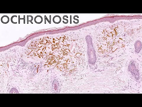 Exogenous Ochronosis (possible side effect of hydroquinone skin lightening cream) pathology dermpath