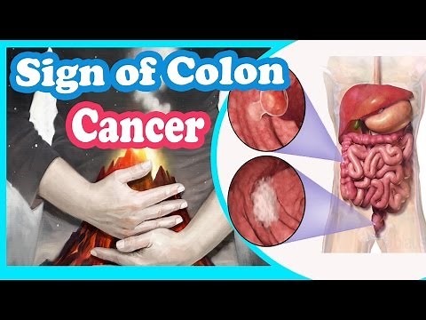 Signs And Symptoms of Colon Cancer You Should Not Ignore
