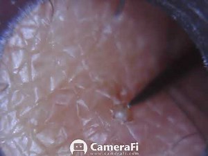 SEE WHAT COMES OUT! Infected ingrown hair removed 1 of 2