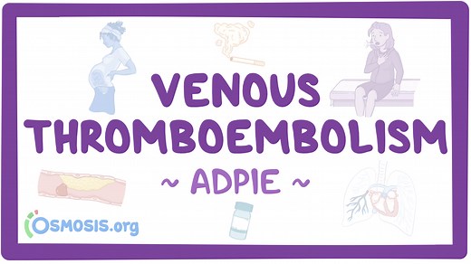 Venous thromboembolism (VTE): Nursing process (ADPIE): Video, Causes, & Meaning | Osmosis