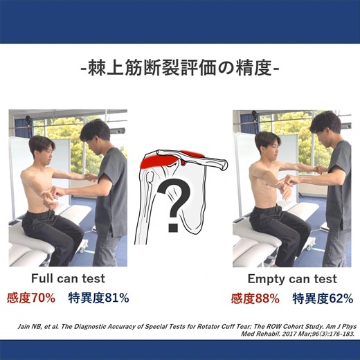 郷間 光正 on Instagram: "【棘上筋断裂評価の精度】 棘上筋断裂の評価として Full can test と Empty can test は 臨床でよく用いられる徒手検査です。 両者は見た目が似ていますが、 診断特性には多少違いがあります。 - Full can test- ・感度：70% ・特異度：81% 偽陽性が比較的少なく、 「断裂がない」ことを確認する目的に向く検査。 - Empty can test- ・感度：88% ・特異度：62% 感度が高く、「断裂を疑うスクリーニング」として有用。 これらのことから ✔ 見逃したくない場合は→ Empty can ✔ 確認したい 場合は Full can という役割の違いを理解して使い分けることが重要だと思います。 ※私はPTなのであくまで評価ですが🙇 またEmpty canでは ・肩甲骨前傾 ・インピンジメント肢位 ・三角筋や疼痛の影響 を受けやすく、「陽性＝棘上筋断裂」と短絡しないことも重要だと思っています。 徒手検査は 単独で診断するものではなく、 問診・動作・他検査と統合して解釈するものですので、検査の「やり方